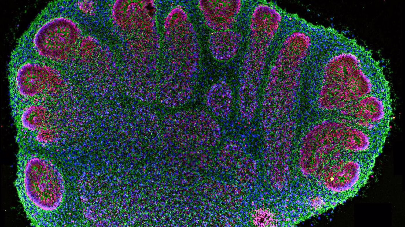 Brain organoids are helping researchers, but raise ethical questions : Shots